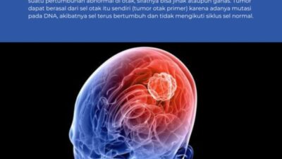 Pemkab Bojonegoro Ajak Warga Kenali Gejala Tumor Otak Sejak Dini